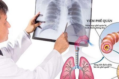 4 triệu người Việt mắc hen phế quản, cần làm gì để giảm đợt cấp trên bệnh nhân?