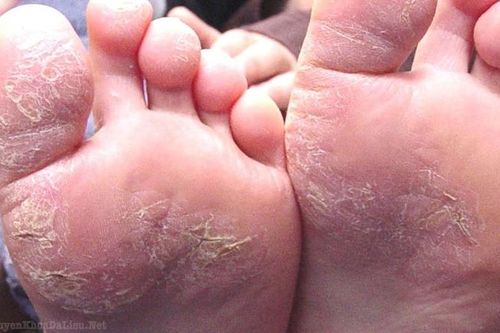 Phòng bệnh á sừng tái phát vào mùa đông