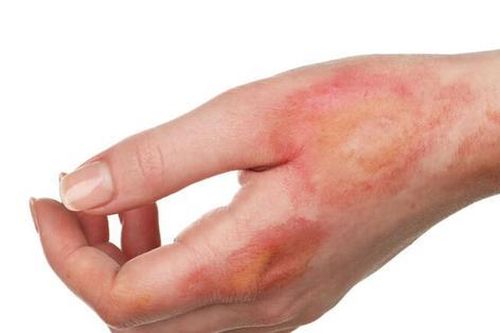 Bác sĩ hướng dẫn cách xử trí khi bị bỏng