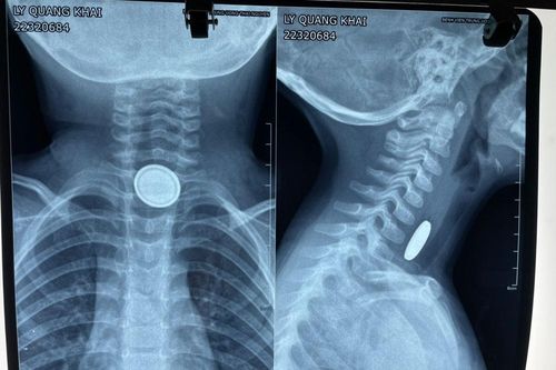 Nội soi gắp bỏ viên pin trong thực quản bệnh nhi 3 tuổi