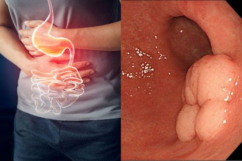 Nhờ dấu hiệu đơn giản người phụ nữ phát hiện mình bị ung thư