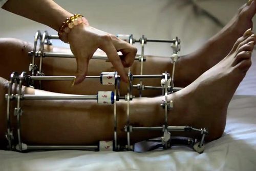 Nỗi uất ức khiến nhiều người chọn phẫu thuật kéo dài chân