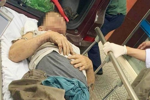 Thùng phuy dầu phát nổ, một Giám đốc doanh nghiệp bị thương nặng