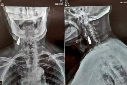 Cụ ông bị đạn găm trong cổ suốt 77 năm mà không biết