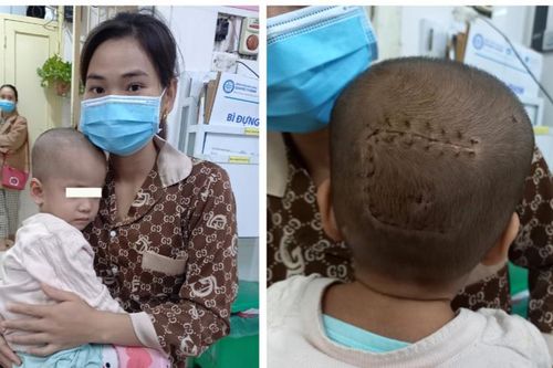 Lấy khối u màng não ở vị trí hiểm cứu bé 2 tuổi