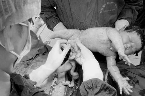Mổ cấp cứu kịp thời cho sản phụ Hà Nội 39 tuần bị suy thai