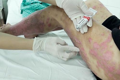 Nhiều trường hợp nhập viện do tự ý sử dụng thuốc chữa vảy nến mua trên mạng