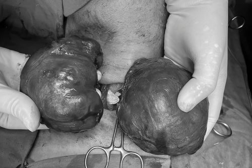 Hy hữu: Bóc khối u khổng lồ to bằng quả bưởi sống cùng bệnh nhân 15 năm
