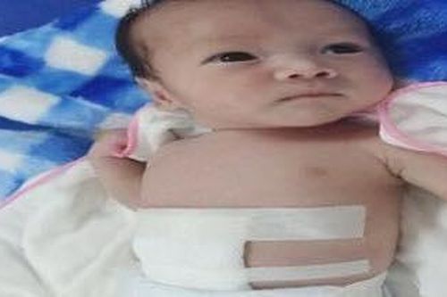 Cứu sống bé sơ sinh có ruột nằm hoàn toàn ngoài ổ bụng