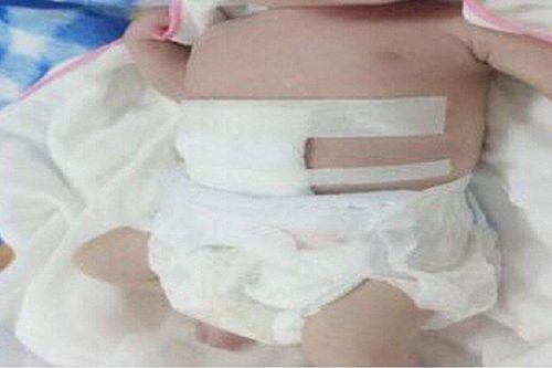 Hi hữu: Bé sơ sinh chào đời với ruột nằm ngoài ổ bụng
