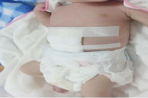 Cứu sống bé sơ sinh chào đời có ruột nằm ngoài ổ bụng
