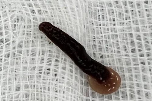 Người đàn ông uống nước suối bị con đỉa dài 5cm chui vào mũi