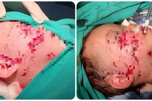 Bé 28 tháng tuổi bị chó cắn nát mặt