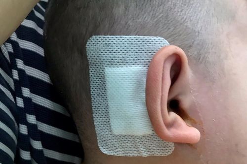 Cấy ốc tai điện tử cho bé trai bị điếc bẩm sinh, máu khó đông