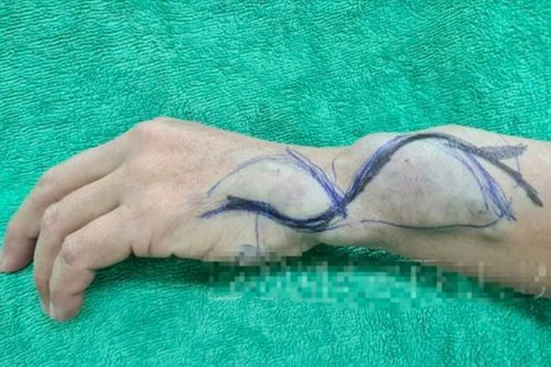 Phẫu thuật cho nữ bệnh nhân có khối dị dạng mạch máu bất thường ở tay