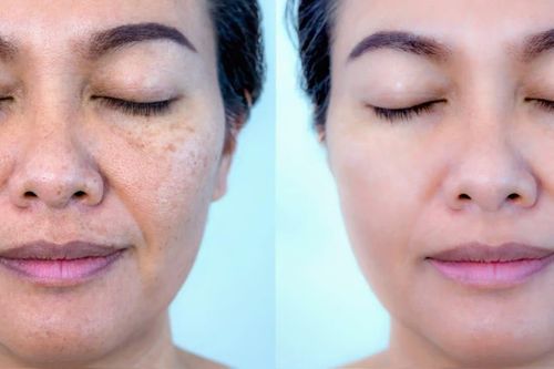 Mối nguy đằng sau những nỗ lực làm trắng da