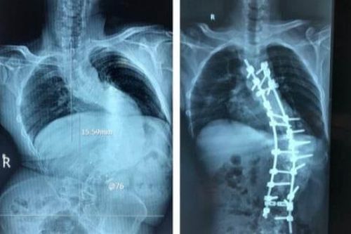 Phẫu thuật lấy lại hình dạng cho người đàn ông bị gù vẹo cột sống hơn chục năm