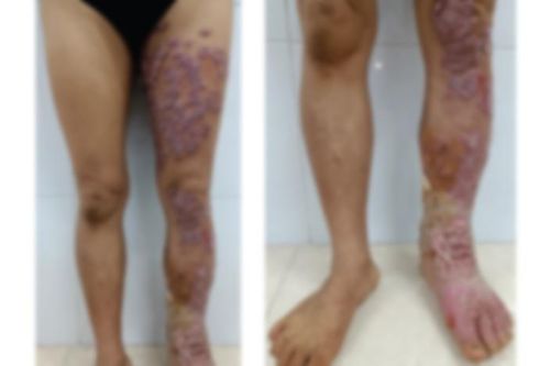 Nữ bệnh nhân mắc căn bệnh nấm da được WHO gọi là bệnh nhiệt đới 'bị lãng quên'