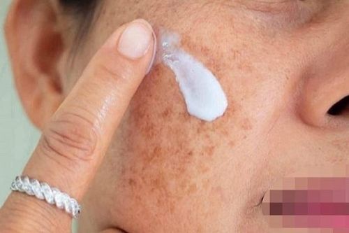 Cảnh báo mẫu kem chuyên nám có hàm lượng thủy ngân vượt mức