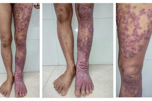 Biến dạng chân trái vì căn bệnh nhiệt đới bị lãng quên