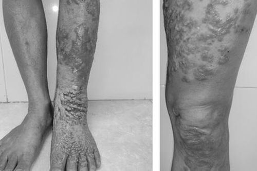 Nhiễm loại nấm da 'bị lãng quên', chân nữ bệnh nhân sần sùi, to như chân voi