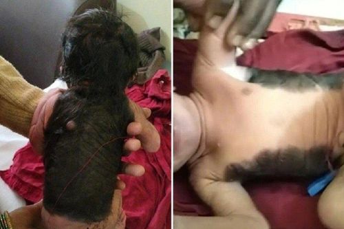 Hi hữu: Cậu bé sinh ra đã có lông, tóc khắp nửa người