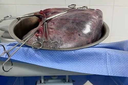 Bé trai được sinh ra cùng khối u nang buồng trứng 8kg trong bụng mẹ