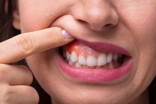 Loét miệng kiểu này nên đi khám ngay kẻo ung thư mà không biết