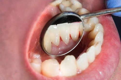 Chảy máu chân răng là dấu hiệu của 5 bệnh nguy hiểm, chớ nên xem thường