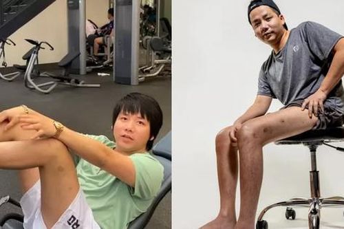 Chi tiền tỷ để kéo dài chân, diện mạo của YouTuber Khoa Pug hiện tại trông thế nào?