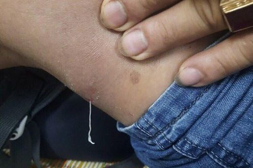 Người đàn ông kéo ra sinh vật lạ dưới da khi gãi ngứa