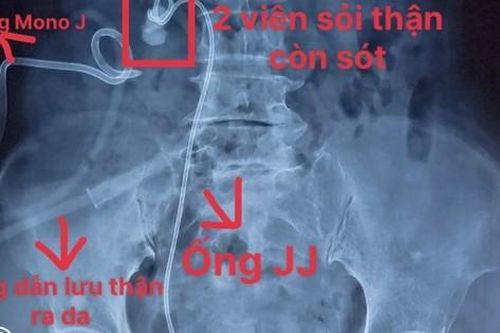 Phẫu thuật nội soi 1 lỗ (mini PCNL) ở tư thế nằm ngửa cho bệnh nhân bị sót sỏi, thận mủ và áp xe quanh thận