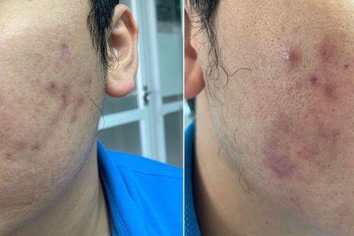 Biến chứng sau tiêm meso để làm đẹp