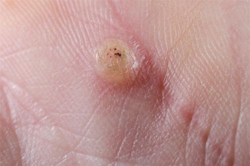 2 công thức giúp bạn trị mụn cóc tại nhà