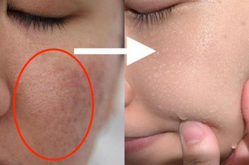 Sản phẩm cần dùng để cải thiện 3 kiểu lỗ chân lông to phát sinh khi da lão hóa