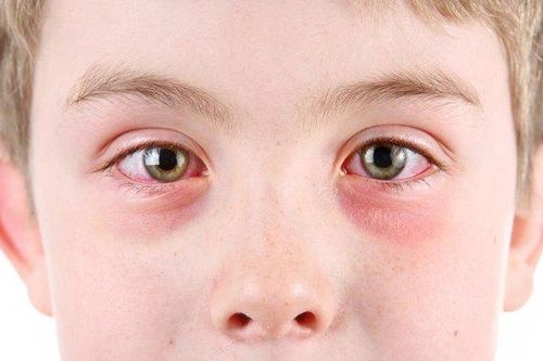 Các loại dị ứng mắt và triệu chứng để phân biệt chính xác nhất