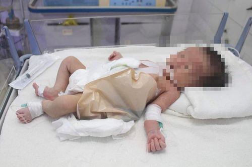 Trẻ sơ sinh chào đời tại nhà không có hậu môn, 1 tuần sau mới được đưa đi khám