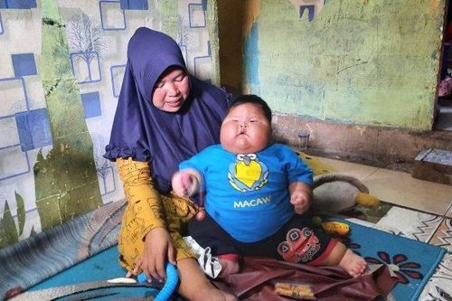 Indonesi: Bé trai 16 tháng nặng 27 kg được hỗ trợ giảm cân