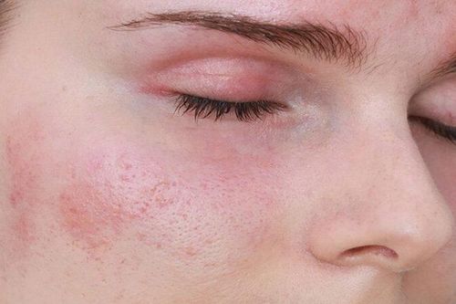 Cách xử trí nám da do dùng retinol chống lão hóa