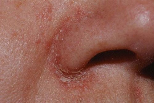 Dấu hiệu nhận biết bệnh viêm da tiết bã nhờn