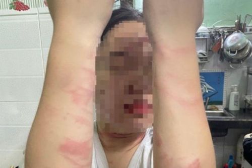 Điều tra vụ việc thiếu nữ 17 tuổi bị mẹ ruột đánh gây thương tích ở TP Thủ Đức