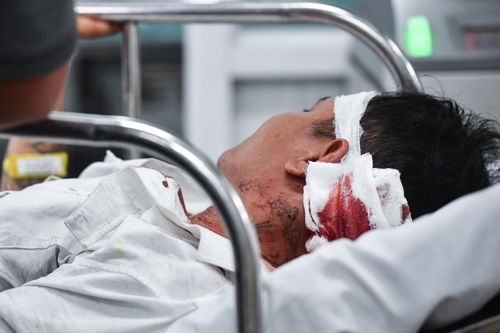 Người đàn ông nhập viện với cẳng tay đứt lìa