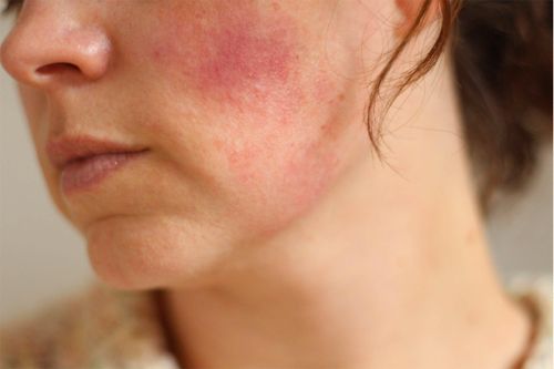 Dấu hiệu của da khi sử dụng mỹ phẩm chứa Corticoid