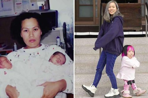 Cặp song sinh có chiều cao chênh lệch đạt kỷ lục thế giới
