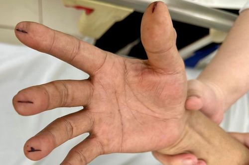 Nhập viện với vết dao lam cứa sâu vì làm theo 'thầy thuốc online'