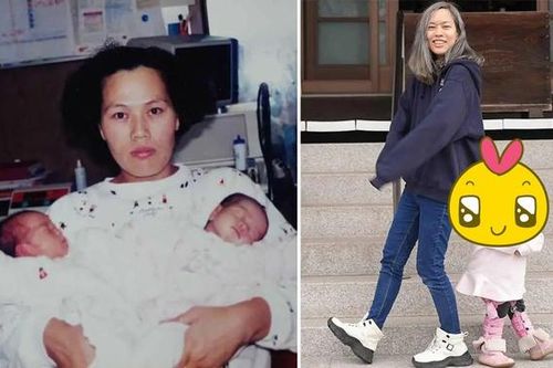 Cặp sinh đôi kỳ lạ nhất thế giới: Chào đời giống y đúc, ngoại hình lúc trưởng thành gây bất ngờ