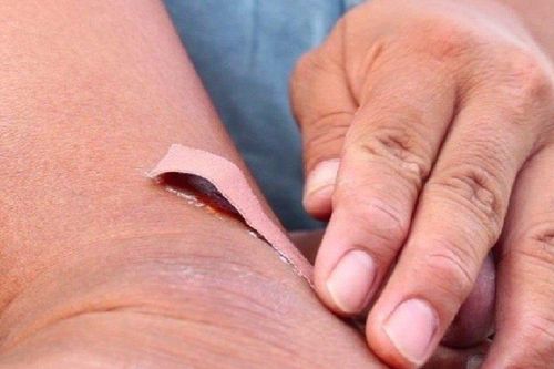 Cụ bà tử vong sau nhiều ngày đắp lá chữa gãy xương