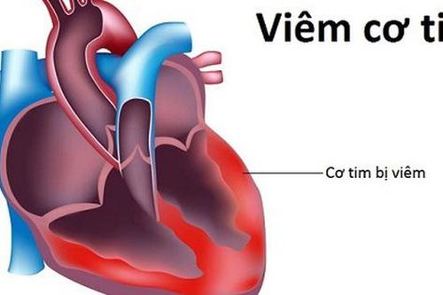 Nguyên nhân viêm cơ tim và các triệu chứng báo hiệu cần biết