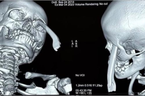 Cứu thành công bé gái bị tay phanh xe đạp đâm thẳng hốc mắt, sàn sọ