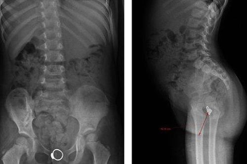 Phát hiện chiếc nhẫn trong vùng kín của bé gái 4 tuổi